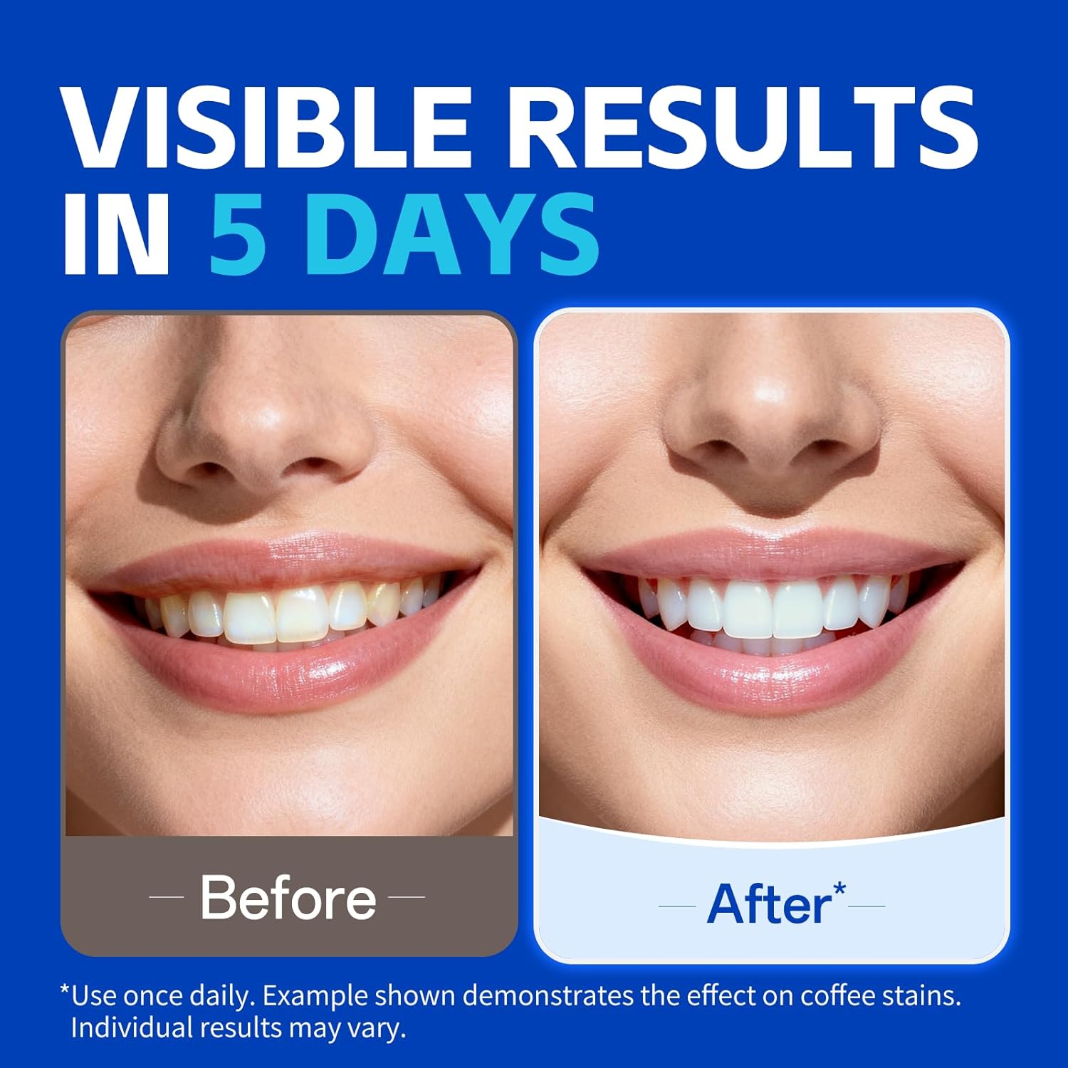 7 pairs Teeth Whitening Strips - Teeth Whitening Street 评论和价格