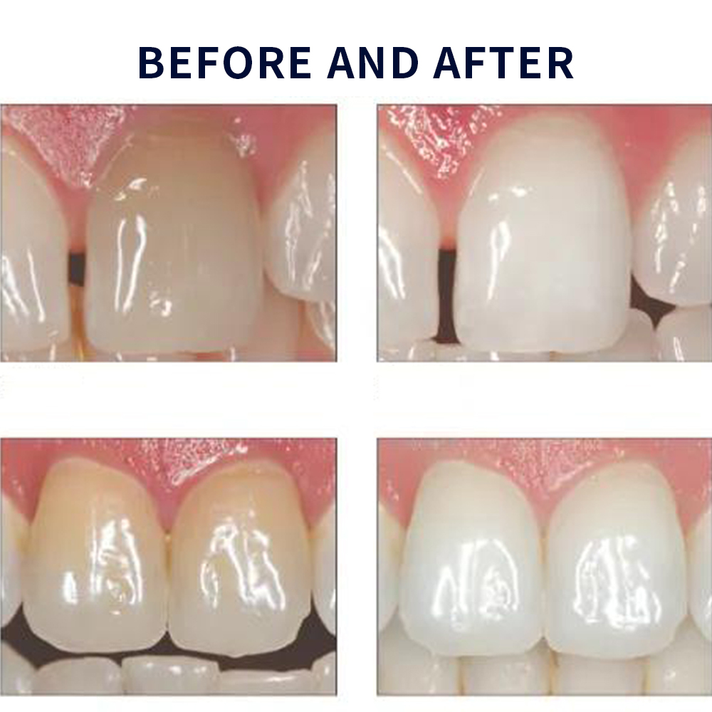 Opalescence Whitening 20% PF 2 - Teeth Whitening Results 评论和价格
