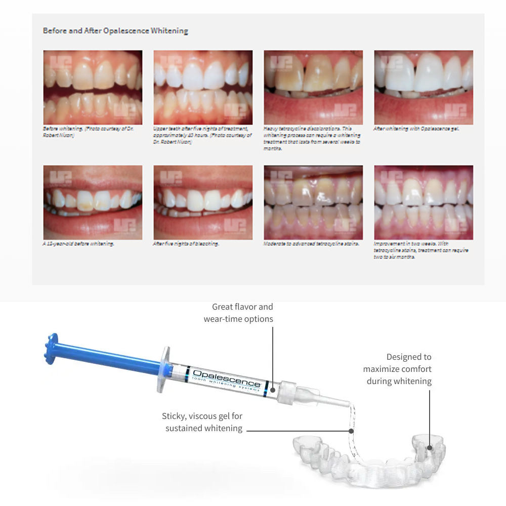 Opalescence Whitening 20% PF 2 - Teeth Whitening Results 评论和价格