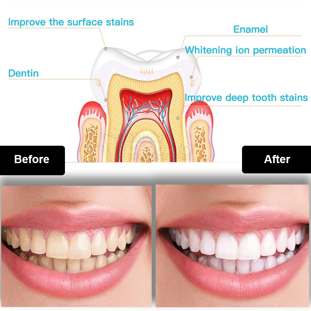 Dental Teeth Whitening Kit Min - Teeth Whitening Device 评论和价格